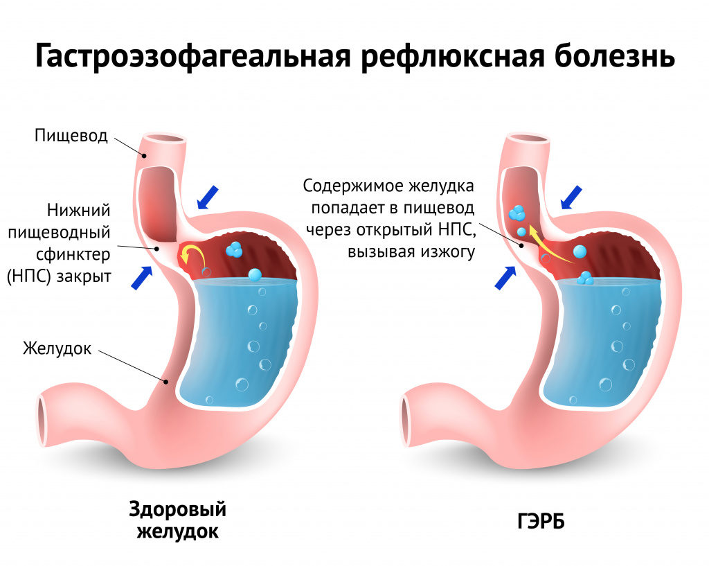 Лечение в Италии гастроэзофагиального рефлюкса